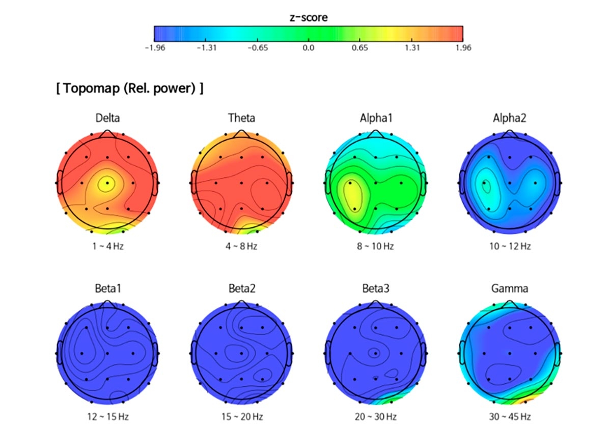How To Interpret QEEG Results NeuroTraining Strategies